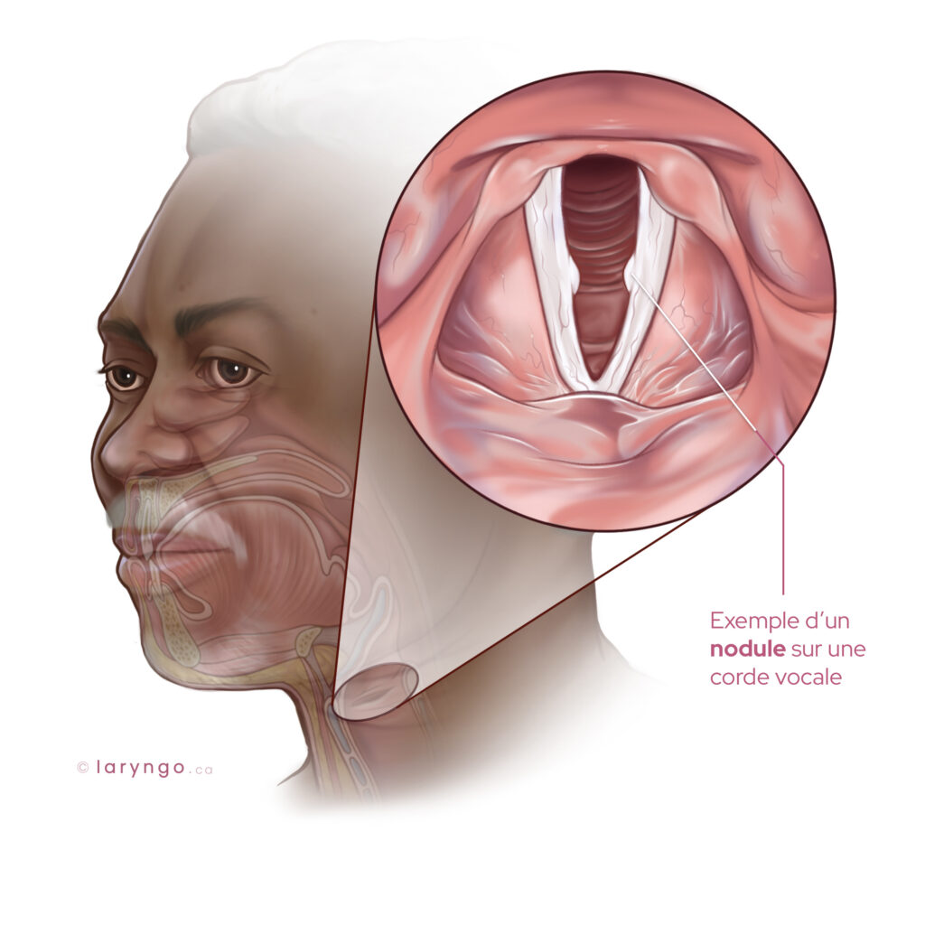 NODULE CORDES VOCALES