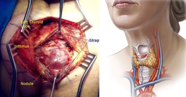 Thyroidectomies